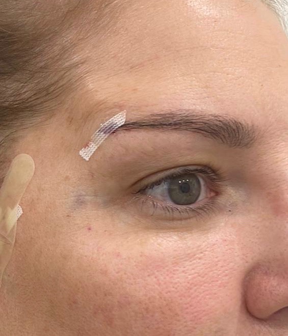 Fox eye thread lift, patient after treatment 01