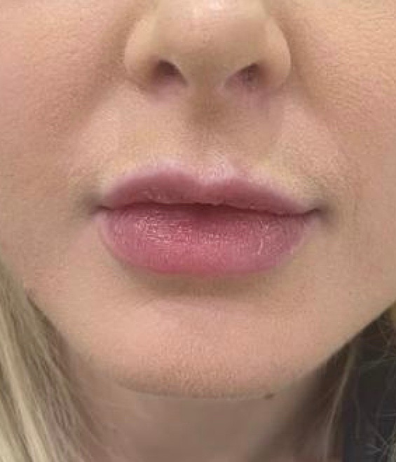 Lip augmentation with fillers, patient 01 before, ACM Clinic Adelaide
