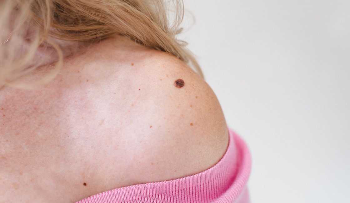 Mole on shoulder, ACM mole removals clinic, patient 02-1