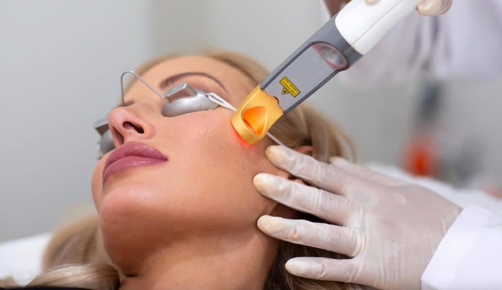 Excel V Vascular Laser in Adelaide Targeting Skin Imperfections with
