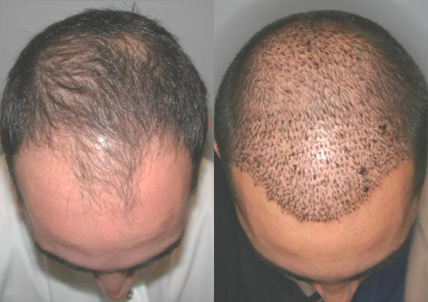 FUE hair transplant before and after 14, male patient, ACM Dr Targett