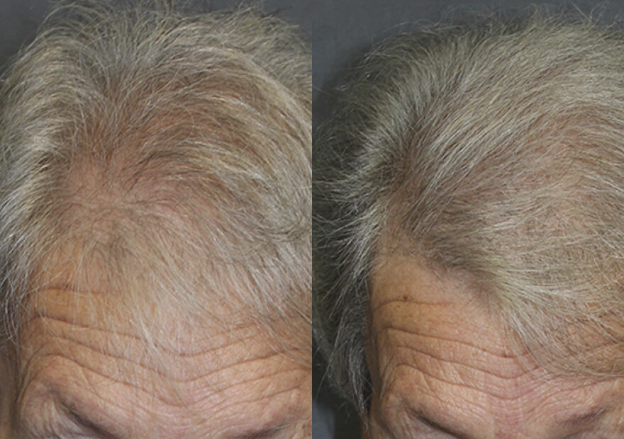 Patient before and after hair transplant 15