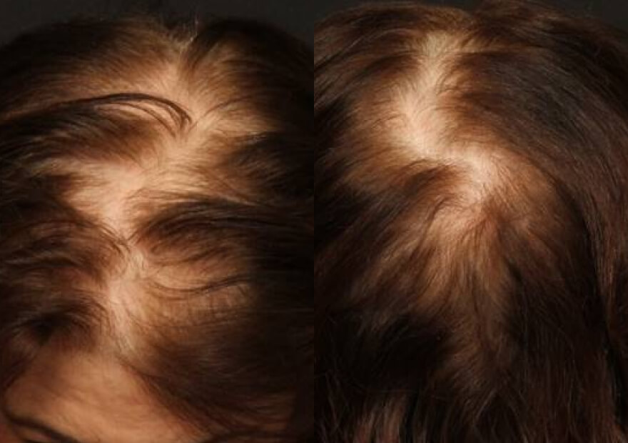 Female Hair Transplant with NeoGraft FUE technology, ACM Clinic