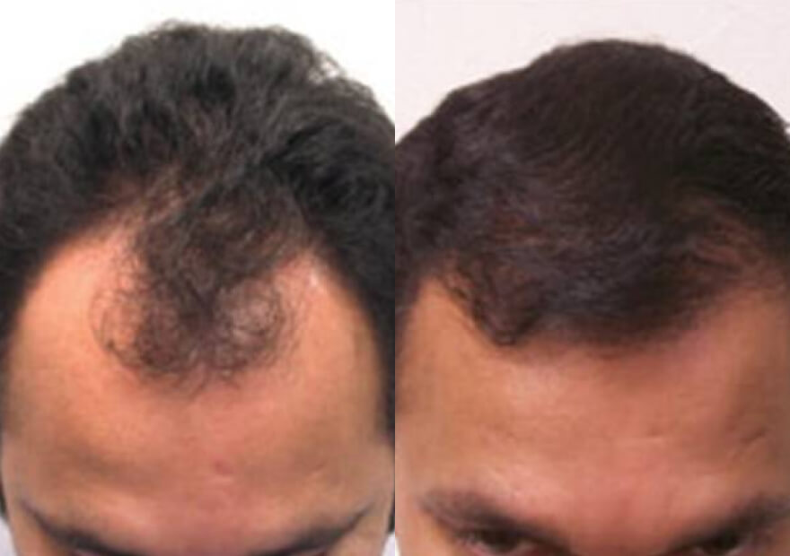 NeoGraft - FUE hair transplant, before and after 18