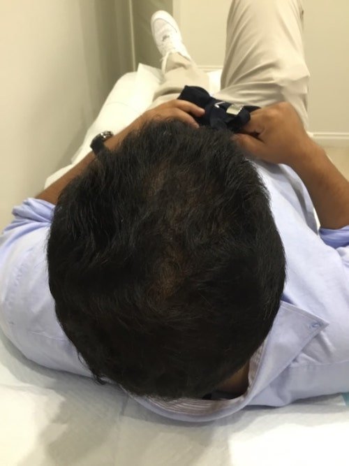 Hair loss treatment patient, after Factor 4 treatment at ACM Clinic in Adelade