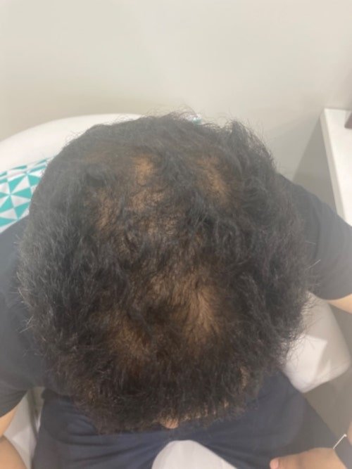 Factor 4 hair loss treatment, patient before treatment