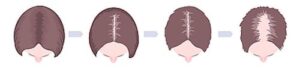 femal pattern baldness