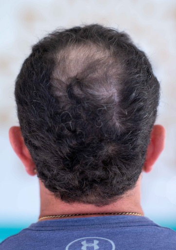 Hair loss treatment patient 02, Factor 4 treatment, ACM Clinic Adelaide