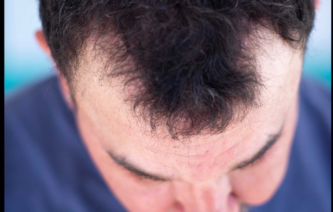 hair loss treatment - hair growth treatment