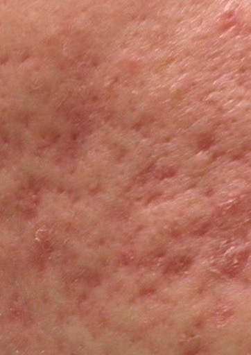Acne scars, closeup photo 02, ACM Clinic