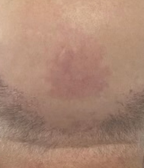 Birthmark after removal, ACM Clinic