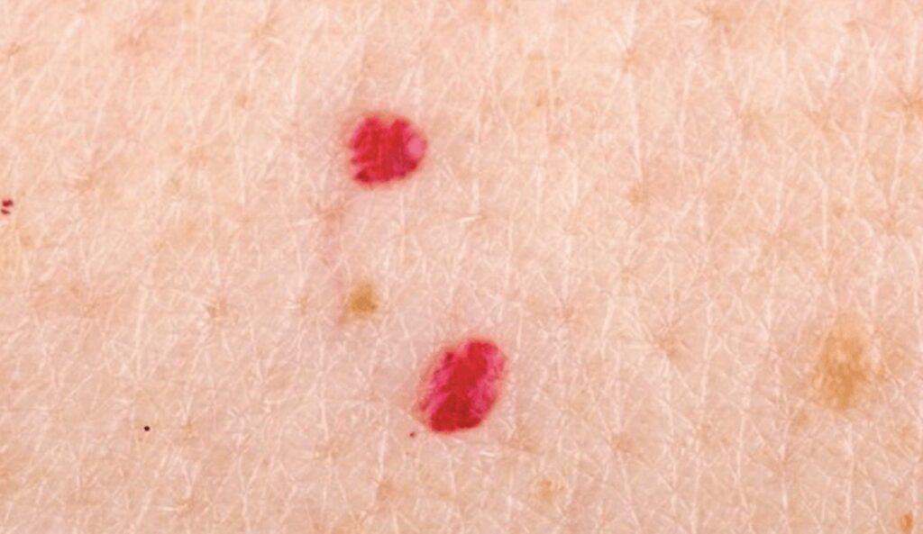 Excel V+ Laser Cherry Angioma Treatment in Adelaide Smooth, Clear Skin