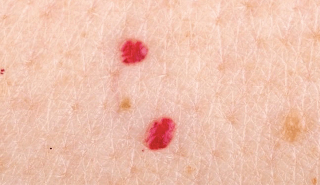 Cherry angioma treatment in ACM Clinic Adelaide