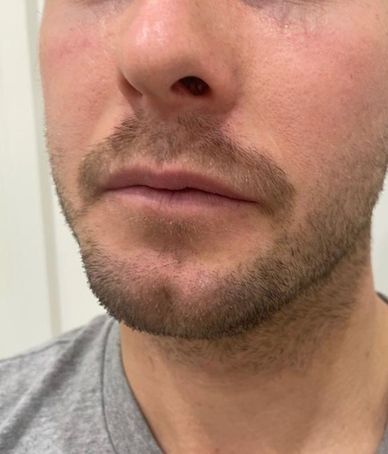Cleft chin treatment before, Dr Targett Adelaide