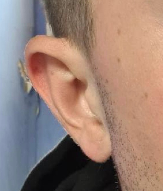 Earlobe repair before and after, ACM patient after procedure