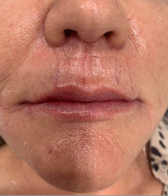 Lip lines treatment, patient after the treatment, before and afters