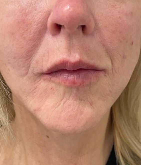 Marionette lines before and afters, ACM patient treatment after