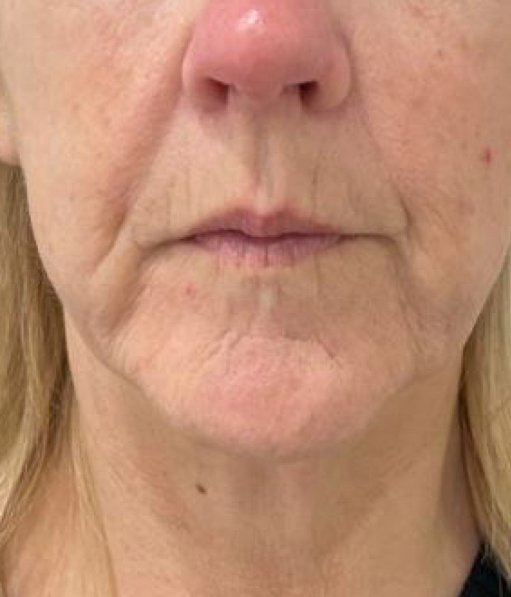 Marionette lines before and after, ACM patient before procedure