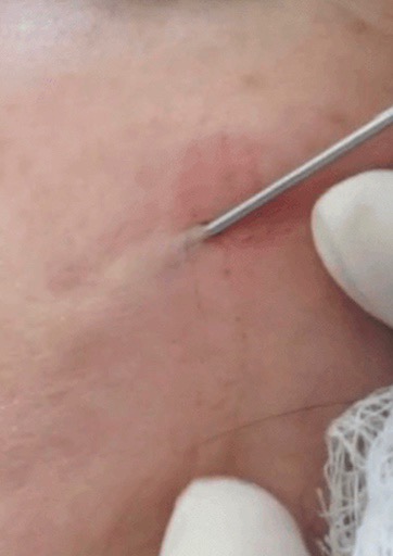subcision acne scar treatment adelaide 2