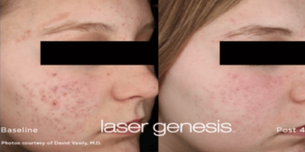 Laser Genesis before and after 01, ACM Clinic Adelaide