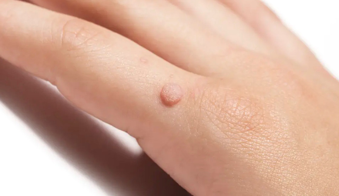wart removal adelaide