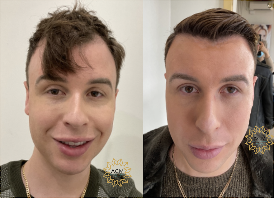 ACM HAIR TRANSPLANT 2 BEFORE AND AFTER