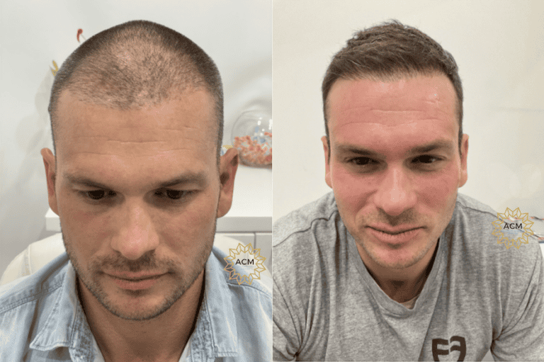 Revitalize Your Look NeoGraft FUE Hair Transplant for Natural Results