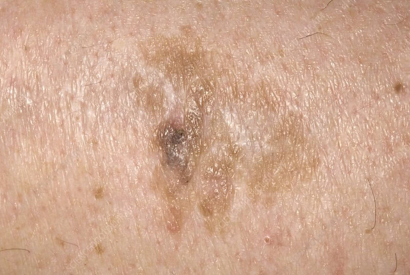 Solar Keratosis Removal