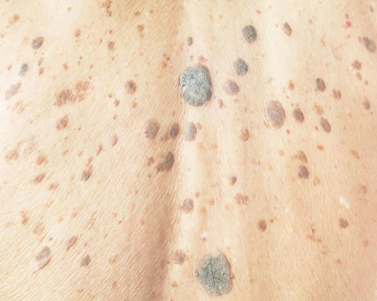 Seborrheic Keratosis removal