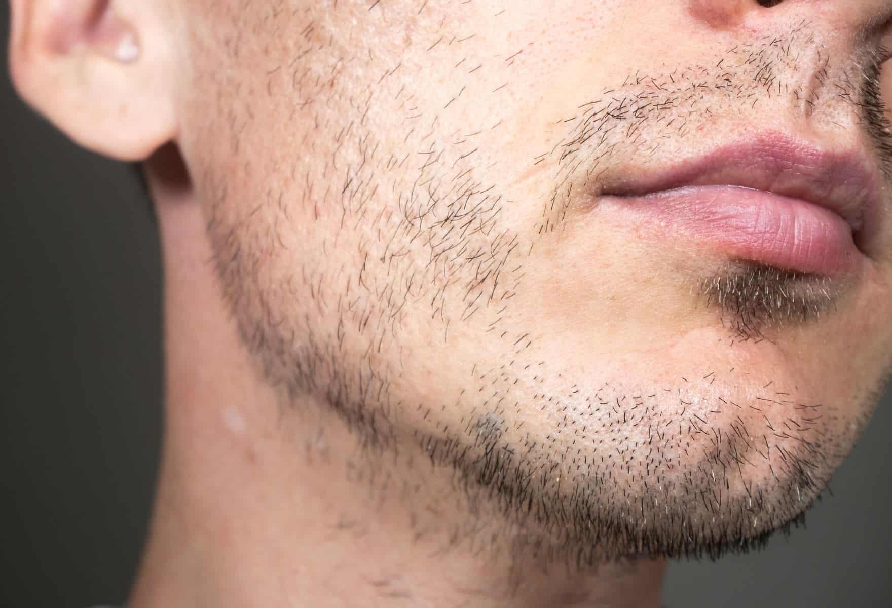 BEARD TRANSPLANT ADELAIDE