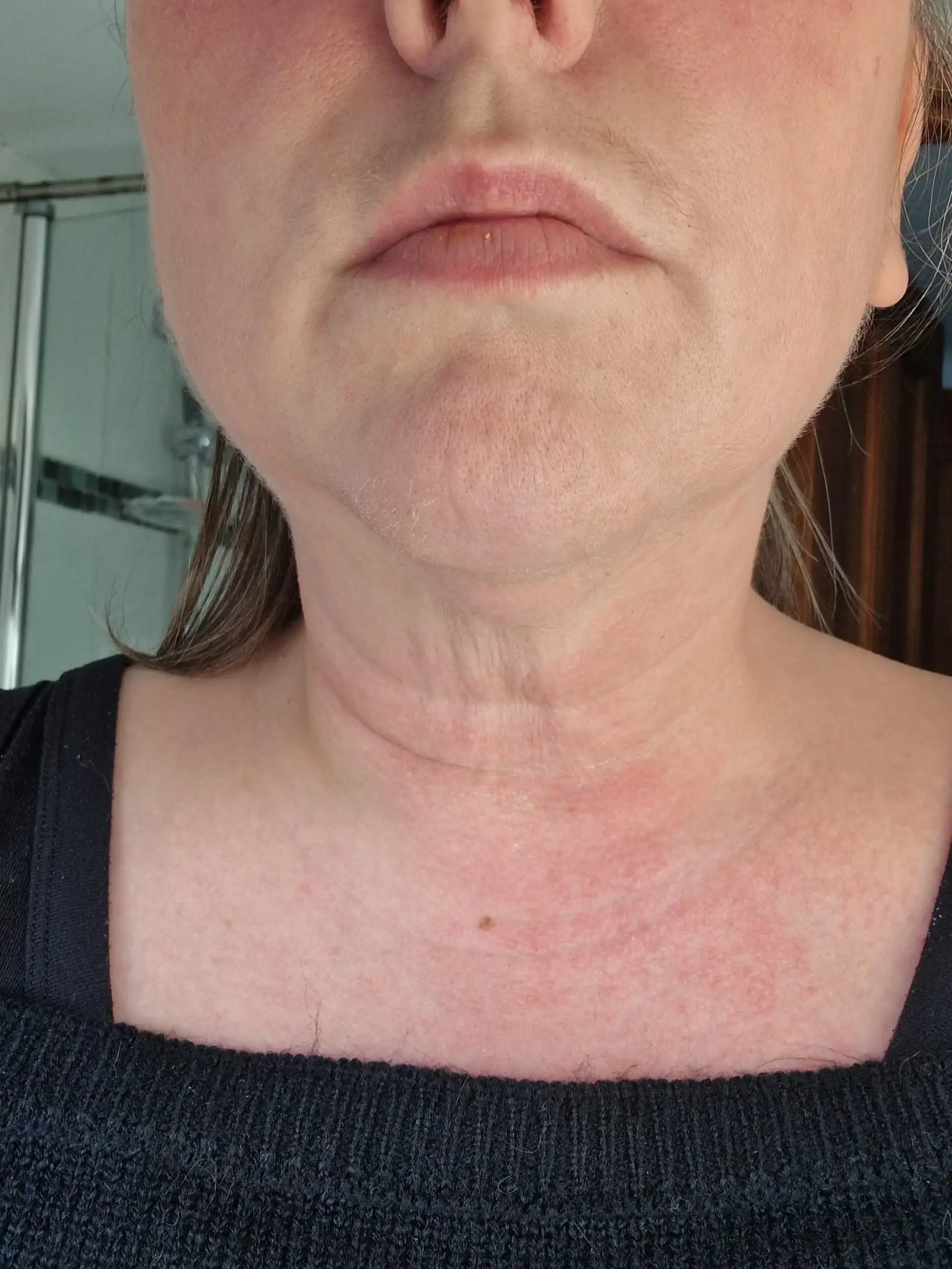sagging neck skin