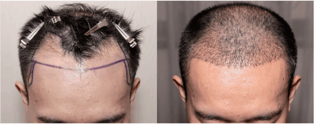 how long do hair transplants last