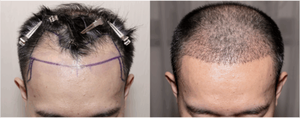 how long do hair transplants last