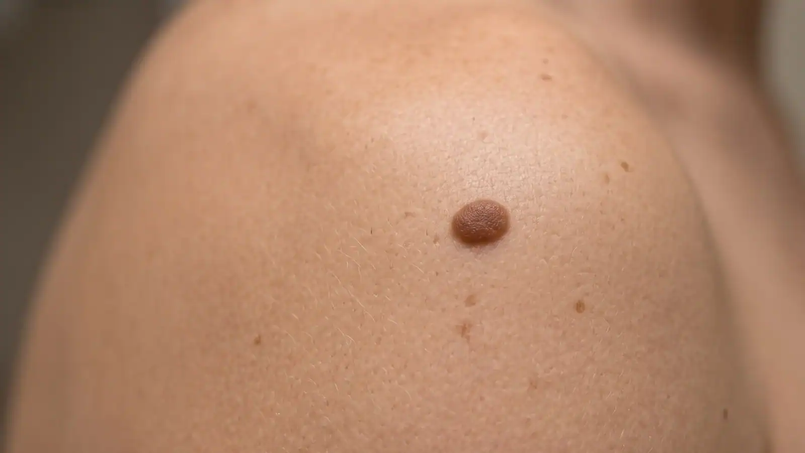 Close view of a raised brown mole on the skin of an adult's shoulder
